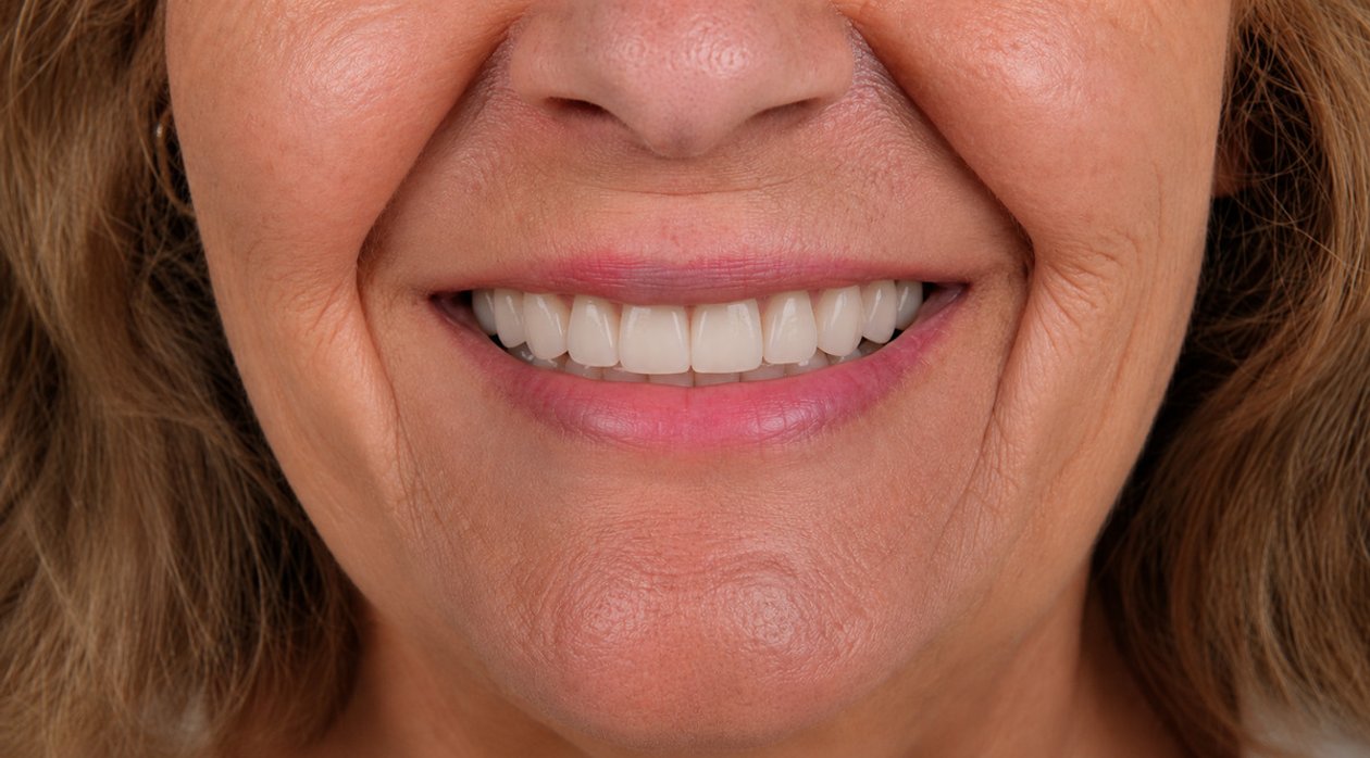 Smile after treatment